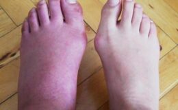 Makrodaktili hasatlığı nedir? Makrodaktili hastalığının belirtileri nelerdir?